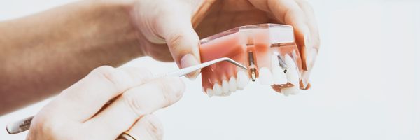 Zubné implantáty | DENT+ Zubná klinika