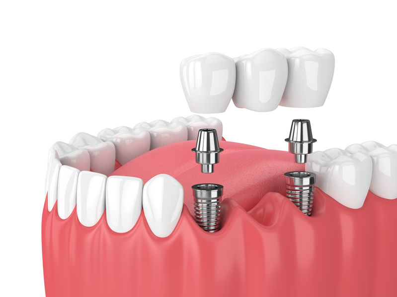 Zavádzanie zubného implantátu | DENT+ Zubná klinika