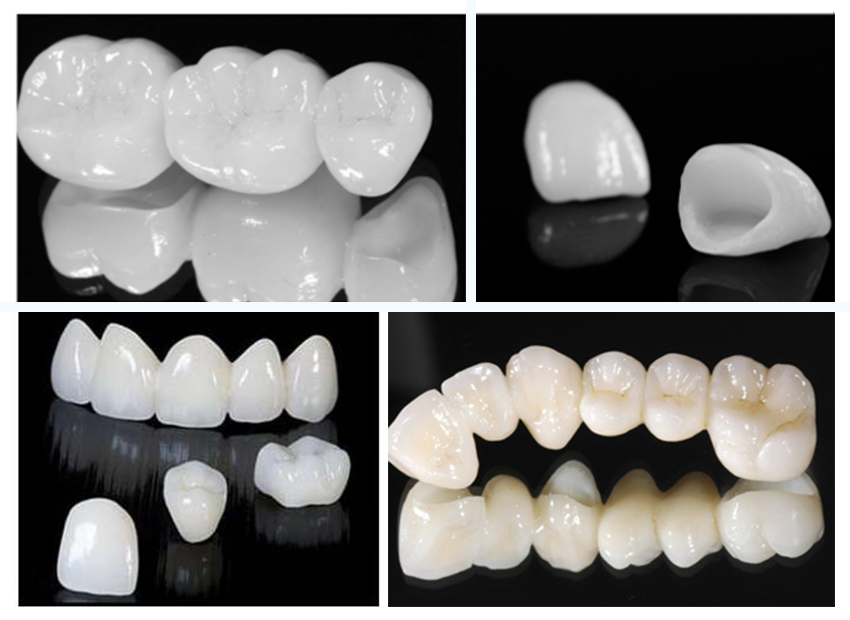 Celokeramické a zirkónové náhrady | DENT+ Zubná klinika