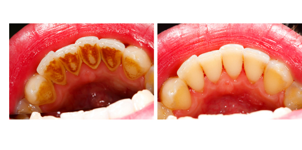 Dentálna hygiena | DENT+ Zubná klinika